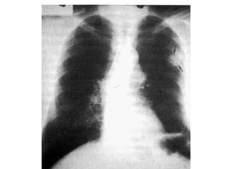 CANCER PULMON 2.pptx