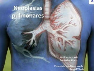 Neoplasias
pulmonares




                  Medicina Interna II
                  Dra: Yadira Alvarez

             Presentado por: Gustavo Avila
                            Samuel Villeda
 