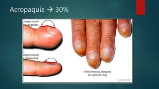 Acropaquia  30%
 
