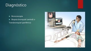 Diagnóstico
 Broncoscopia
 Biopsia bronquial (central) o
Transbronquial (periférico)
 