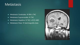 Metástasis
 Metástasis Cerebrales  RM o TAC
 Metástasis Suprarrenales  TAC
 Metástasis Hepática  TAC o ECO ABD
 Metástasis Ósea  Gammagrafia ósea
 