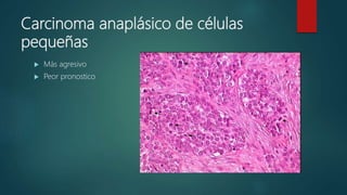 Carcinoma anaplásico de células
pequeñas
 Más agresivo
 Peor pronostico
 