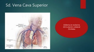 Sd. Vena Cava Superior
1)Edema en esclavina
2)Circulación colateral
3)Cefalea
 