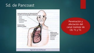 Sd. de Pancoast
Penetración y
afectación del
canal medular de
C8, T1 y T2.
 