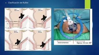 Mofified Rullier Classification cancer recto tto ultimo lap.pptx
