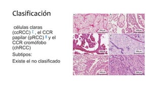 Clasificación
células claras
(ccRCC) 7 , el CCR
papilar (pRCC) 8 y el
CCR cromófobo
(chRCC)
Subtipos:
Existe el no clasificado
 
