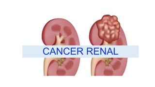 CANCER RENAL
 