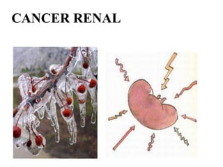 CANCER RENAL
 