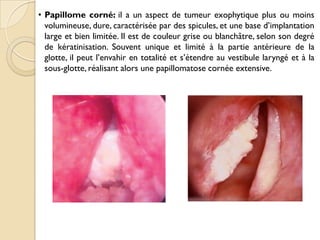 • Papillome corné: il a un aspect de tumeur exophytique plus ou moins
volumineuse, dure, caractérisée par des spicules, et une base d’implantation
large et bien limitée. Il est de couleur grise ou blanchâtre, selon son degré
de kératinisation. Souvent unique et limité à la partie antérieure de la
glotte, il peut l’envahir en totalité et s’étendre au vestibule laryngé et à la
sous-glotte, réalisant alors une papillomatose cornée extensive.
 