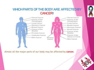 Cancer slides | PDF