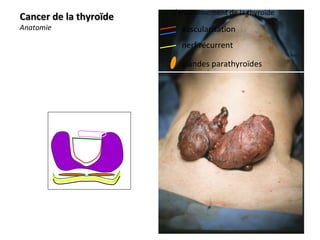 Cancers thyroïde cours IFSI 3ieme année | PPT