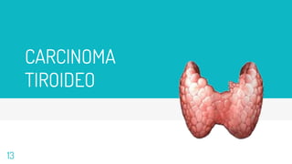 CARCINOMA
TIROIDEO
13
 