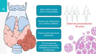 18 Masa sólida irregular
firme no encapsulado
Puede invadir estructuras
adyacentes
10% de pacientes
presentan enfermedad
metastásica al momento
de diagnóstico
Tiende a ser multicéntrico
en un lóbulo y bilateral
 