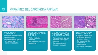 VARIANTES DEL CARCINOMA PAPILAR
19
FOLICULAR
• Variante mas frecuente
• Encapsulado
• Características típicas
nucleares del
carcinoma papilar.
ESCLEROSANTE
DIFUSO
• Niños y adultos
jovenes
• Se presenta con bocio
• Multifocal
CELULAS ALTAS
Y COLUMNARES
• Tumor grande que se
extiende fuera de la
glándula.
• Se presentan con
invasión vascular.
ENCAPSULADA
• Capsula similar a un
adenoma pero con
invasion focal.
• Se encuentran los
cuerpos de
psammoma.
• 8-13% de los casos
 