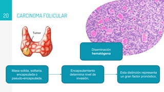 CARCINOMA FOLICULAR
20
Masa solida, solitaria,
encapsulada o
pseudo-encapsulada.
Esta distinción representa
un gran factor pronóstico.
Encapsulamiento
determina nivel de
invasión.
Diseminación
hematógena
 