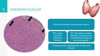 CARCINOMA FOLICULAR
21
Carcinoma folicular mínimamente invasivo
50% de los
casos de
carcinoma
folicular
DX: demonstrar invasión
vascular y la ausencia de
características típicas de
carcinoma papilar.
Citológicamente indistinguibles de adenoma
folicular.
 
