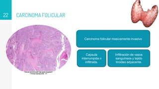 CARCINOMA FOLICULAR
22
Carcinoma folicular masivamente invasivo
Capsula
interrumpida o
infiltrada.
Infiltración de vasos
sanguíneos y tejido
tiroideo adyacente.
 