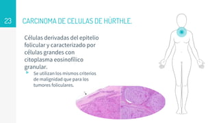 CARCINOMA DE CELULAS DE HÜRTHLE.
Células derivadas del epitelio
folicular y caracterizado por
células grandes con
citoplasma eosinofílico
granular.
▹ Se utilizan los mismos criterios
de malignidad que para los
tumores foliculares.
23
 