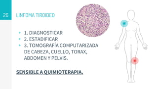 LINFOMA TIROIDEO
▹ 1. DIAGNOSTICAR
▹ 2. ESTADIFICAR
▹ 3. TOMOGRAFÍA COMPUTARIZADA
DE CABEZA, CUELLO, TORAX,
ABDOMEN Y PELVIS.
SENSIBLE A QUIMIOTERAPIA.
26
 