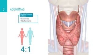 ADENOMAS
6
4:1
• Funcional
• No funcional
Nodulo tiroideo
solitario
 