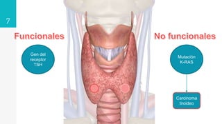 7
Gen del
receptor
TSH
Mutación
K-RAS
Carcinoma
tiroideo
 
