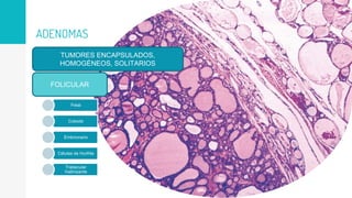 ADENOMAS
TUMORES ENCAPSULADOS,
HOMOGÉNEOS, SOLITARIOS
FOLICULAR
Fetal
Coloide
Embrionario
Células de Hurthle
Trabecular
hialinizante
 
