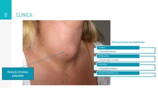 CLÍNICA
9
Nódulo tiroideo
palpable
• Compresión traqueal
DISNEA
• Irritación del N. Laríngeo
RONQUERA
• Compresión esofágica
DISFAGIA
HIPERTIROIDISMO (1%)
Otros síntomas acompañantes
 