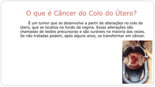 O que é Câncer do Colo do Útero?
É um tumor que se desenvolve a partir de alterações no colo do
útero, que se localiza no fundo da vagina. Essas alterações são
chamadas de lesões precursoras e são curáveis na maioria das vezes.
Se não tratadas podem, após alguns anos, se transformar em câncer.
 