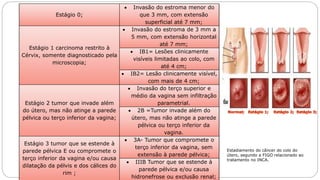 Estágio 0;
 Invasão do estroma menor do
que 3 mm, com extensão
superficial até 7 mm;
Estágio 1 carcinoma restrito à
Cérvix, somente diagnosticado pela
microscopia;
 Invasão do estroma de 3 mm a
5 mm, com extensão horizontal
até 7 mm;
 IB1= Lesões clinicamente
visíveis limitadas ao colo, com
até 4 cm;
 IB2= Lesão clinicamente visível,
com mais de 4 cm;
Estágio 2 tumor que invade além
do útero, mas não atinge a parede
pélvica ou terço inferior da vagina;
 Invasão do terço superior e
médio da vagina sem infiltração
parametrial.
 2B =Tumor invade além do
útero, mas não atinge a parede
pélvica ou terço inferior da
vagina.
Estágio 3 tumor que se estende à
parede pélvica E ou compromete o
terço inferior da vagina e/ou causa
dilatação da pélvis e dos cálices do
rim ;
 3A- Tumor que compromete o
terço inferior da vagina, sem
extensão à parede pélvica;
 IIIB Tumor que se estende à
parede pélvica e/ou causa
hidronefrose ou exclusão renal;
Estadiamento do câncer do colo do
útero, segundo a FIGO relacionado ao
tratamento no INCA.
 