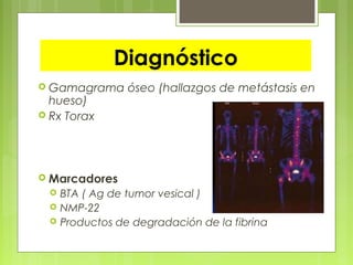 Diagnóstico
 Gamagrama óseo (hallazgos de metástasis en
hueso)
 Rx Torax
 Marcadores
 BTA ( Ag de tumor vesical )
 NMP-22
 Productos de degradación de la fibrina
 