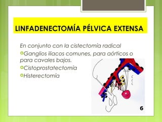 LINFADENECTOMÍA PÉLVICA EXTENSA
En conjunto con la cistectomía radical
Ganglios iliacos comunes, para aórticos o
para cavales bajos.
Cistoprostatectomía
Histerectomía
 