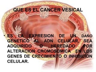 QUE ES EL CANCER VESICAL 
• ES LA EXPRESION DE UN DAÑO 
GENETICO AL ADN CELULAR, SEA 
ADQUIRIDO O HEREDADO POR 
ALTERACION CROMOSOMICA EN LOS 
GENES DE CRECIMIENTO O INHIBICION 
CELULAR. 
 