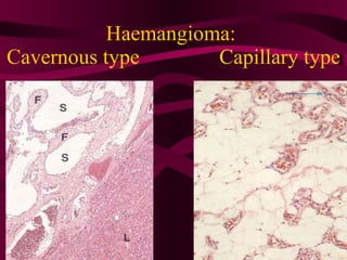 Haemangioma:  Cavernous type  Capillary type 