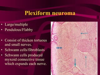 Plexiform neuroma Large/multiple  Pendulous/Flabby Consist of thicken tortuous and small nerves. Schwann cells/fibroblasts Schwann cells produced myxoid connective tissue which expands each nerve.  