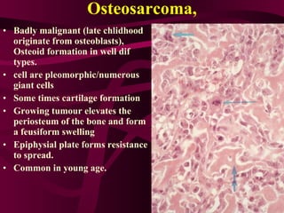 Osteosarcoma, Badly malignant (late chlidhood originate from osteoblasts),  Osteoid formation in well dif types. cell are pleomorphic/numerous giant cells Some times cartilage formation Growing tumour elevates the periosteum of the bone and form a feusiform swelling Epiphysial plate forms resistance to spread. Common in young age. 