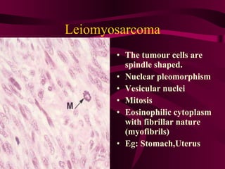 Leiomyosarcoma The tumour cells are spindle shaped. Nuclear pleomorphism Vesicular nuclei Mitosis Eosinophilic cytoplasm with fibrillar nature (myofibrils) Eg: Stomach,Uterus  