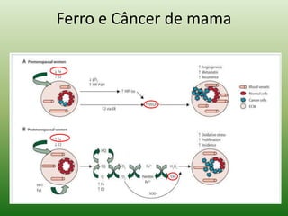 Ferro e Câncer de mama
 
