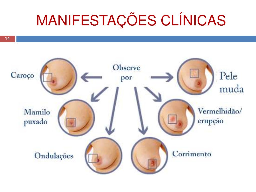 A Evolução Do Câncer Apresenta Três Diferentes Fases