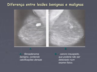 Diferença entre lesões benignas e malignasDiferença entre lesões benignas e malignas
AA BB
A -A - fibroadenoma
benigno, contendo
calcificações densas
B -B - cancro insuspeito,
que poderia não ser
detectado num
exame físico.
 