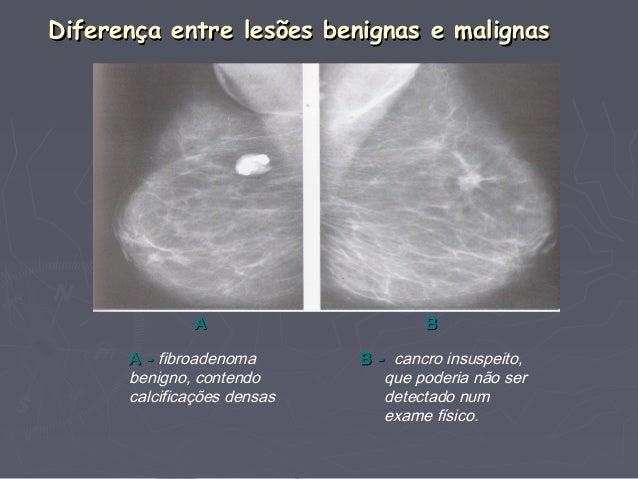 Cancro da mama