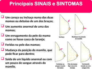  Um caroço ou inchaço numa das duas
mamas ou debaixo de um dos braços;
 Um aumento anormal de uma das
mamas;
 Um enrugamento da pele da mama
como se fosse casca de laranja;
 Feridas na pele das mamas;
 Mudança da posição do mamilo, que
pode ficar para dentro;
 Saída de um líquido anormal ou com
um pouco de sangue através do
mamilo.
Principais SINAIS e SINTOMAS
 