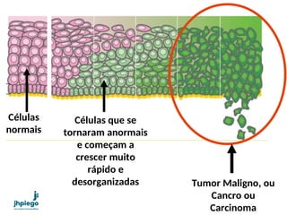 Células
normais
Células que se
tornaram anormais
e começam a
crescer muito
rápido e
desorganizadas Tumor Maligno, ou
Cancro ou
Carcinoma
 