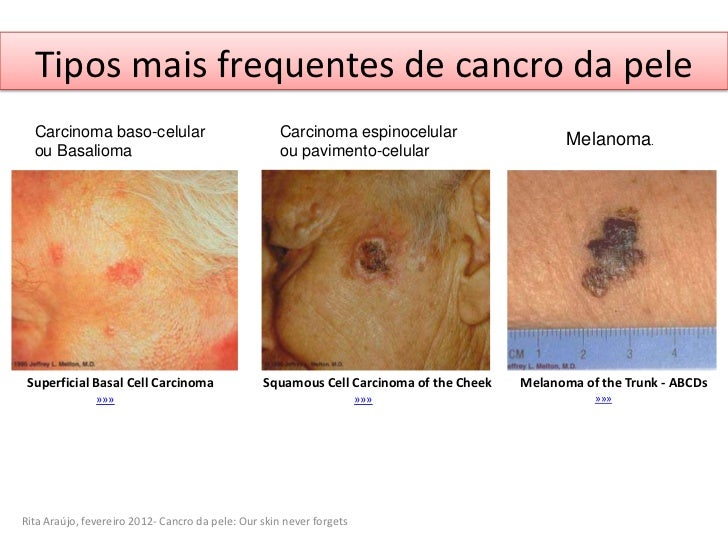 basal cancer #11