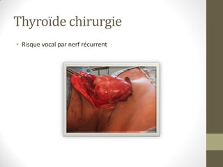 Thyroïde chirurgie
• Risque vocal par nerf récurrent
 