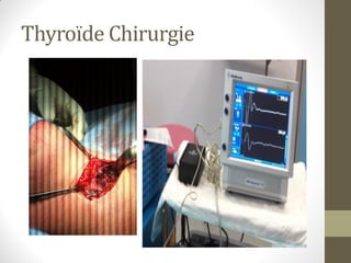 Thyroïde Chirurgie
 