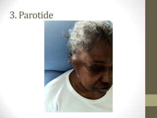 3. Parotide
 