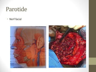 Parotide
• Nerf facial
 