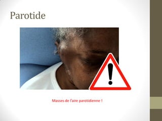 Parotide
Masses de l’aire parotidienne !
 