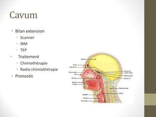 Cavum
• Bilan extension
• Scanner
• IRM
• TEP
• Traitement
• Chimiothérapie
• Radio chimiothérapie
• Pronostic
 