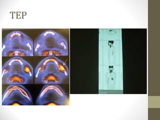 TEP
 